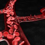 Iron Deficiency Anemia