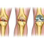 Knee Replacement Surgery