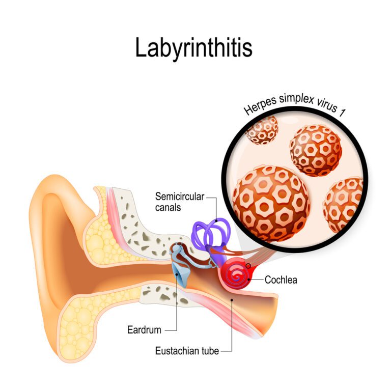 serous-labyrinthitis-illness