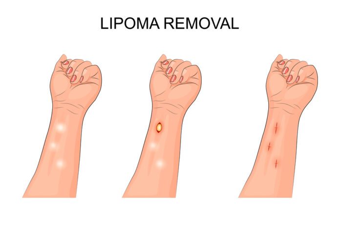 Lipoma