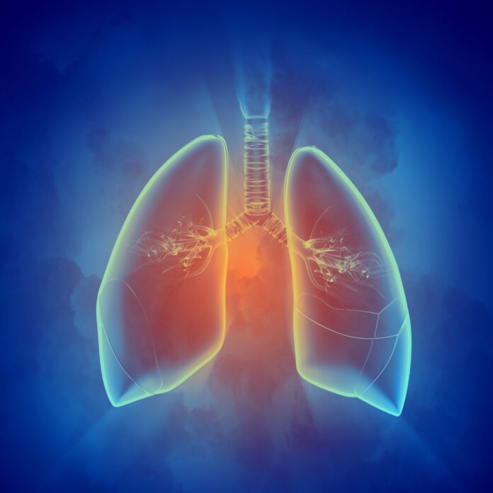 Pulmonary Nocardiosis