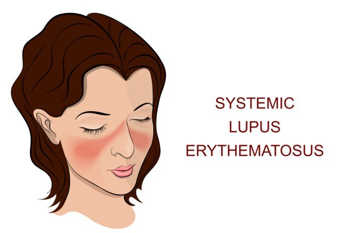 Systemic Lupus Erythematosus