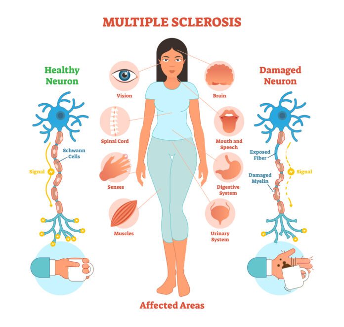 Multiple Sclerosis (MS)