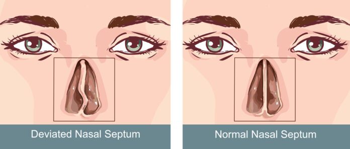 Nasal Septal Perforation Repair