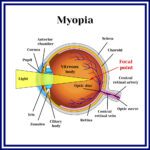 Nearsightedness (Myopia)