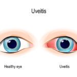 Noninfectious Uveitis