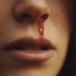 Nosebleeds
