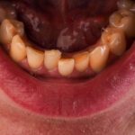Oral Cancer