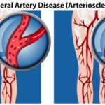 Peripheral Artery Disease (PAD)