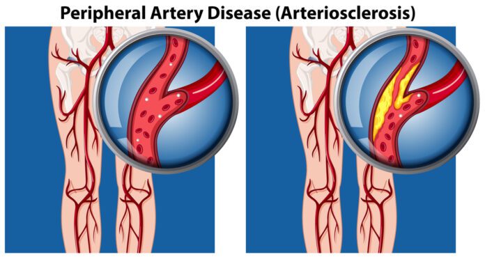 Peripheral Artery Disease (PAD)