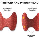 Hyperparathyroidism