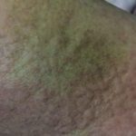 Vibratory Urticaria