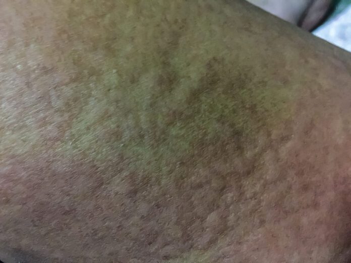 Vibratory Urticaria