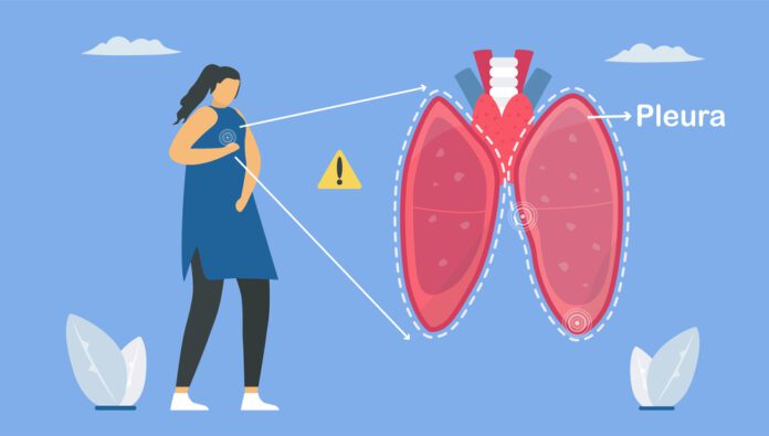 Pleural Effusion