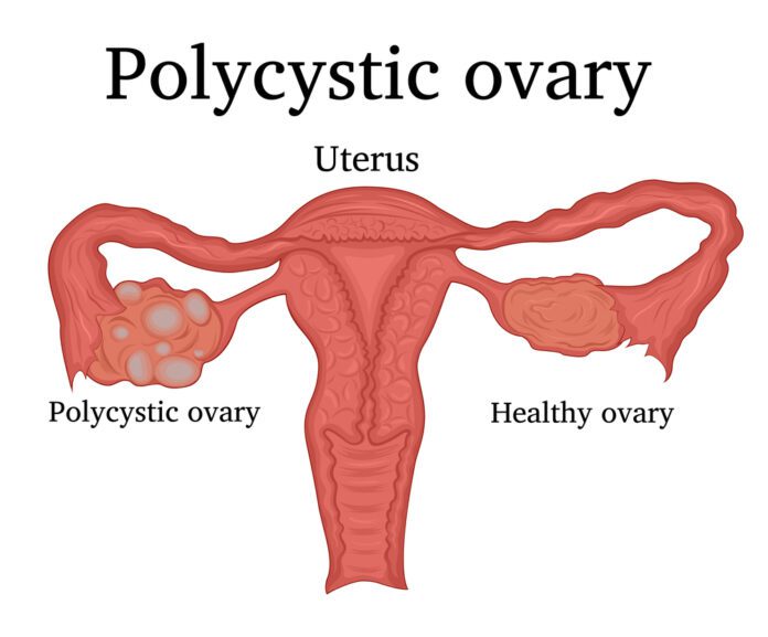 Polycystic Ovary Syndrome (PCOS)