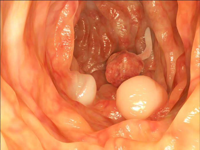 Colorectal Polyps