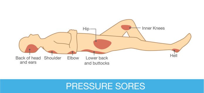 Pressure Sores