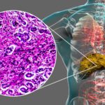 Primary Biliary Cirrhosis (PBC)