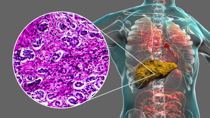 Primary Biliary Cirrhosis (PBC)