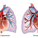 Primary Pulmonary Hypertension