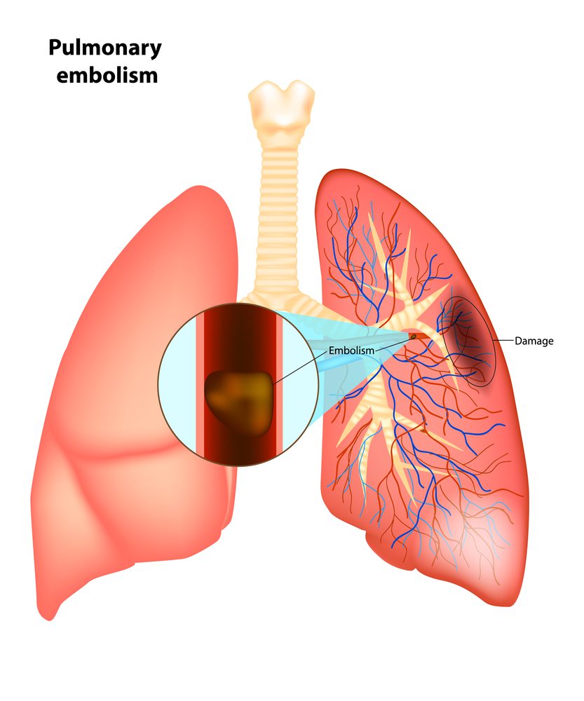 O que embolia pulmonar
