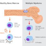 Myeloma - Multiple