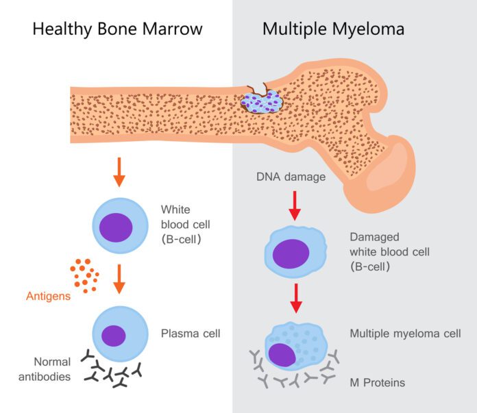 Myeloma - Multiple