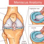 Rehabilitation For A Meniscus Tear