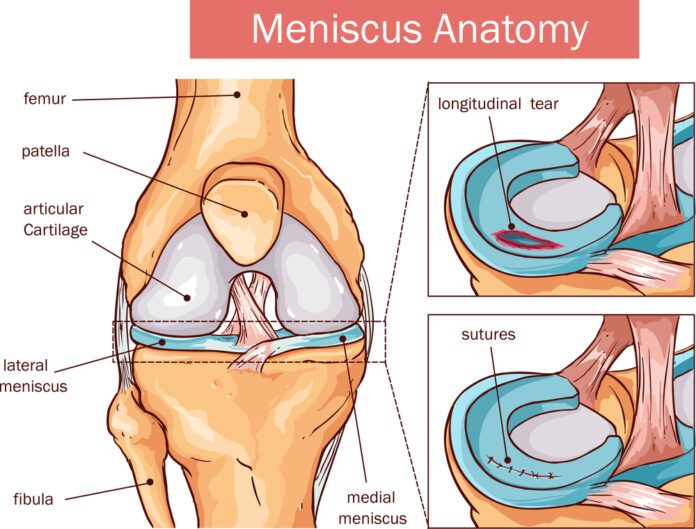 Rehabilitation For A Meniscus Tear