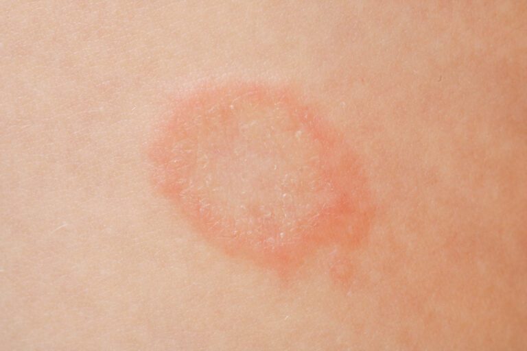 Tinea | Illness.com