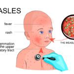 Rubella (Measles)