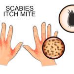 Scabies