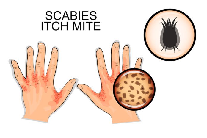 Scabies