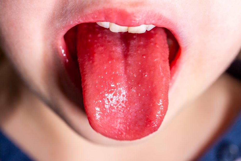 Scarlet Fever Overview Causes Symptoms Treatment