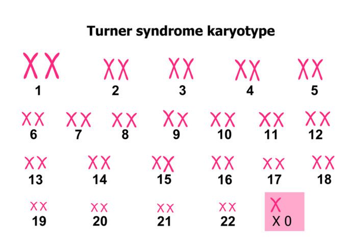 Turner Syndrome