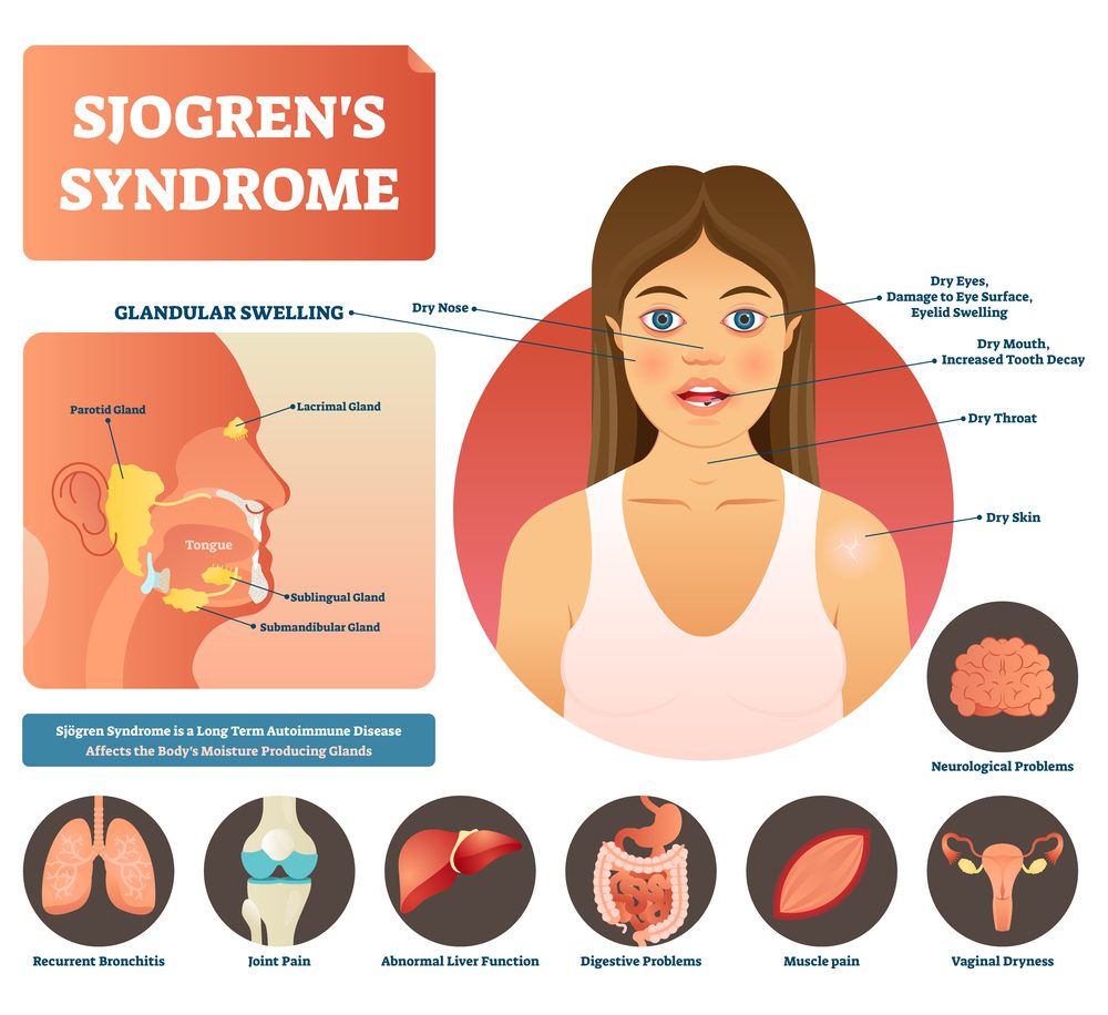 What Is Sjogrens Syndrome Causes Symptoms Diagnosis And Treatment Images