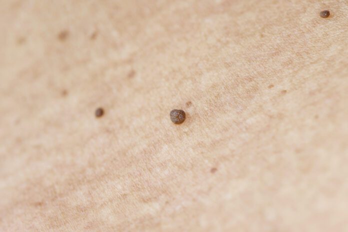 Skin Tags