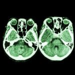 Skull Base Chordoma