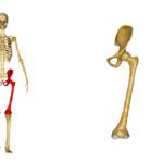 Femoral Epiphysis – Slipped