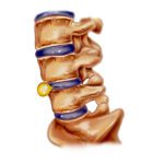 Herniated Disk