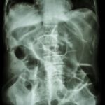 Intestinal Obstruction