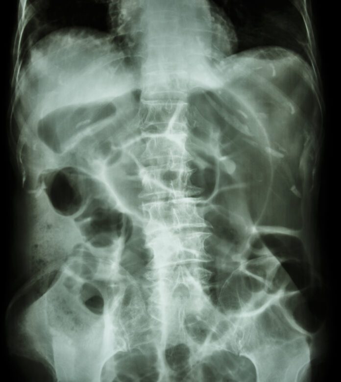 icd 10 ileus paralytic