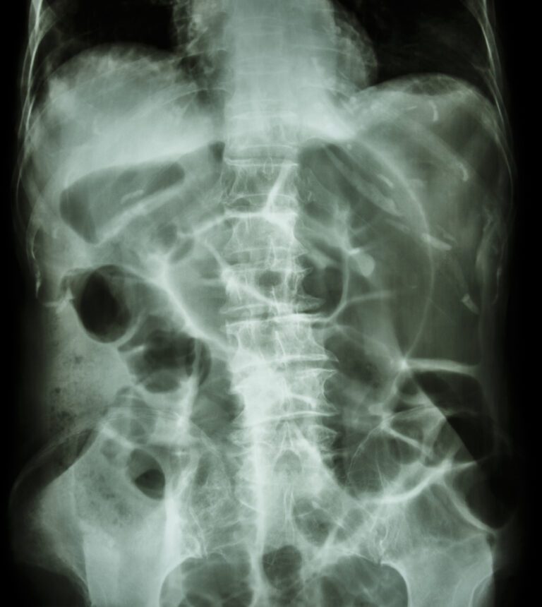 Ileus