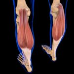 Soft Tissue Sarcoma