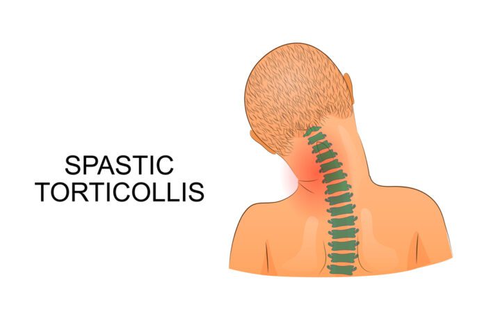 Torticollis