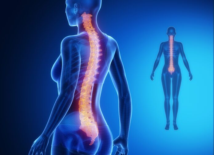 Spinal Chordoma