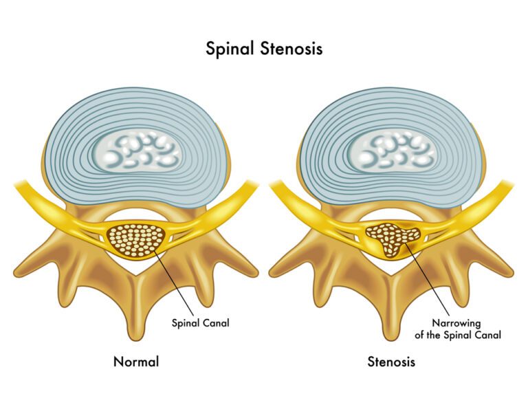 Pseudo Claudication Illness Com