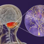 Ataxia - Acute Cerebellar