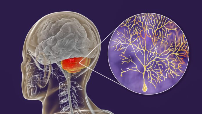 Ataxia - Acute Cerebellar