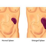 Cryptogenic Polycythemia